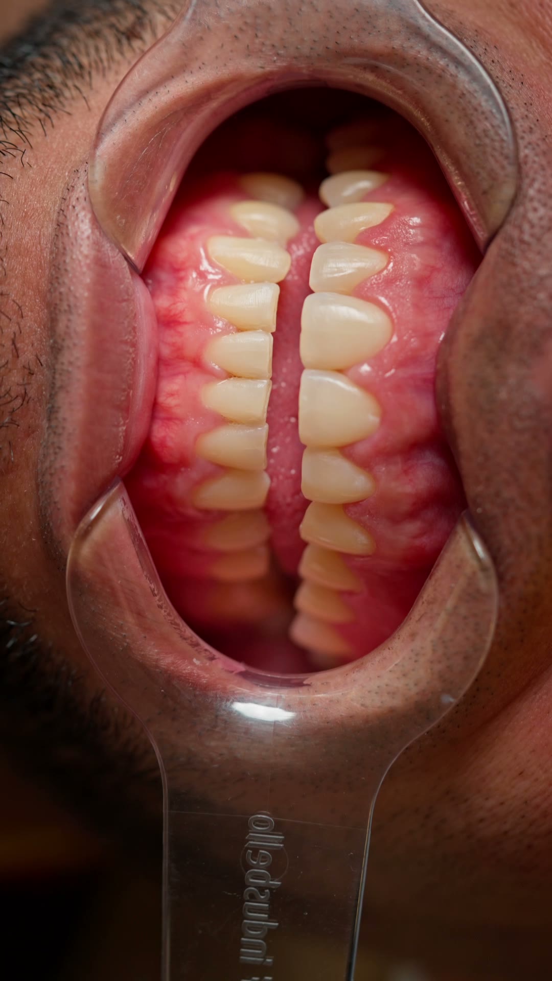 Carillas terminadas, detalle clínico